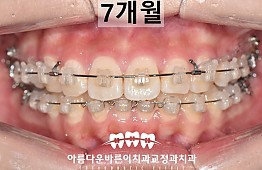 수술후