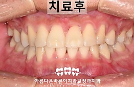 수술후