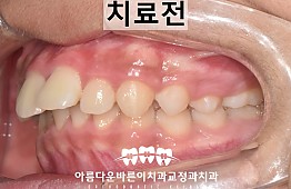 수술전