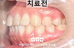 수술전