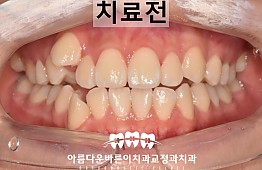 수술전