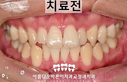 수술전