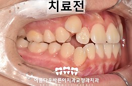 수술전