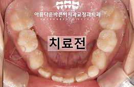수술전