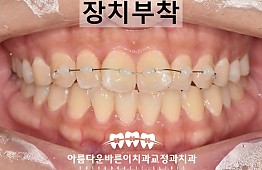 수술후