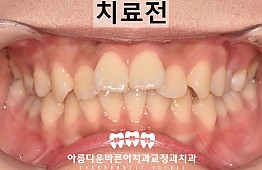 수술전