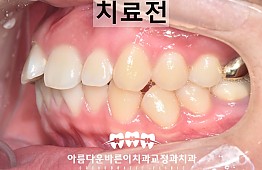 수술전