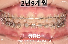 수술후