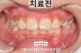 수술전