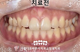 수술전