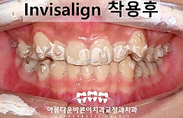 수술후