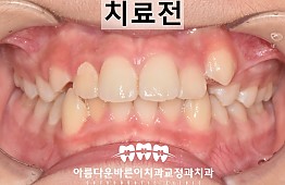 수술전