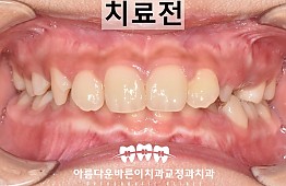 수술전