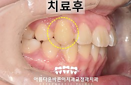 수술후