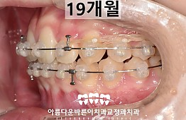 수술후