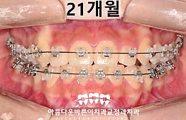 수술후
