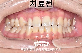 수술전