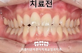 수술전