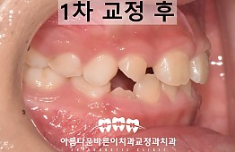 수술후
