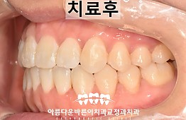 수술후