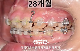 수술후