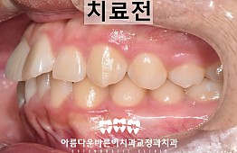 수술전
