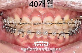 수술후