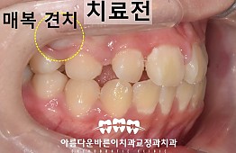 수술전