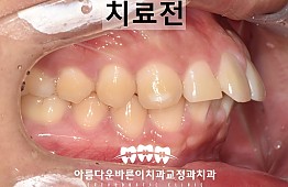 수술전