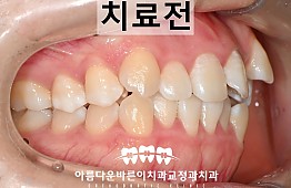 수술전