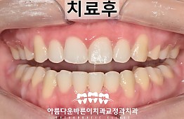 수술후