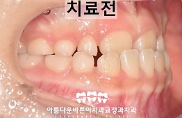 수술전