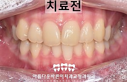 수술전