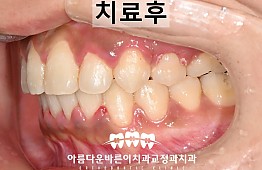 수술후