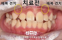 수술전