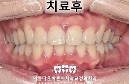 수술후