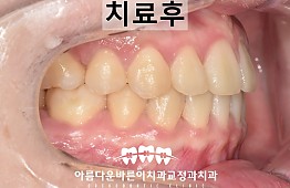 수술후