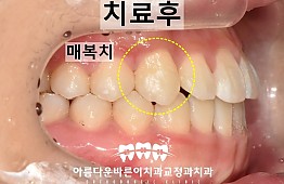 수술후