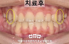 수술후
