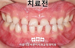 수술전