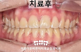 수술후