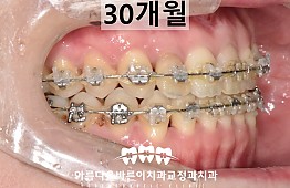 수술후