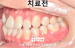 수술전