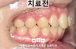 수술전