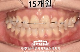 수술후