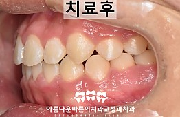 수술후
