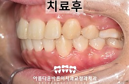 수술후