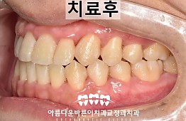수술후