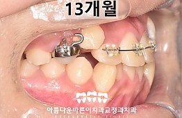 수술후