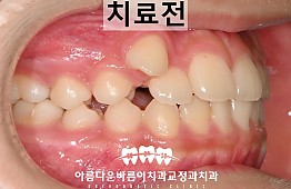 수술전